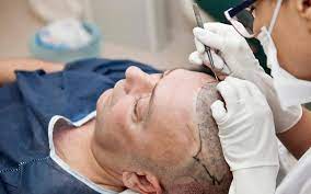 Transform Your Confidence: Top Hair Transplant Clinics in Pune