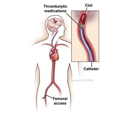 thrombolysis procedure