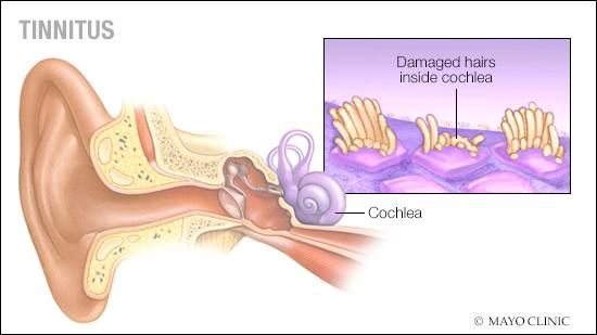 Tinnitus Cure in Pakistan and Insights on ASSR Hearing Test Price