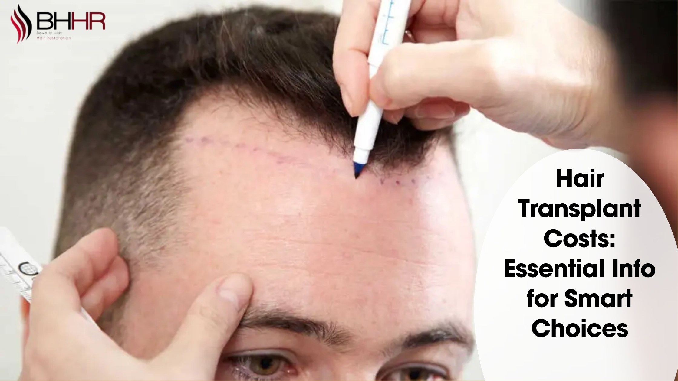 cost of hair transplant