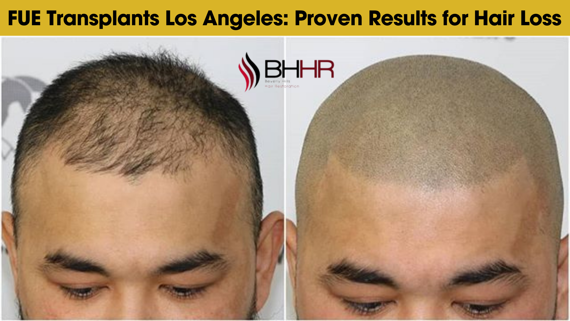 fue transplant Los Angeles