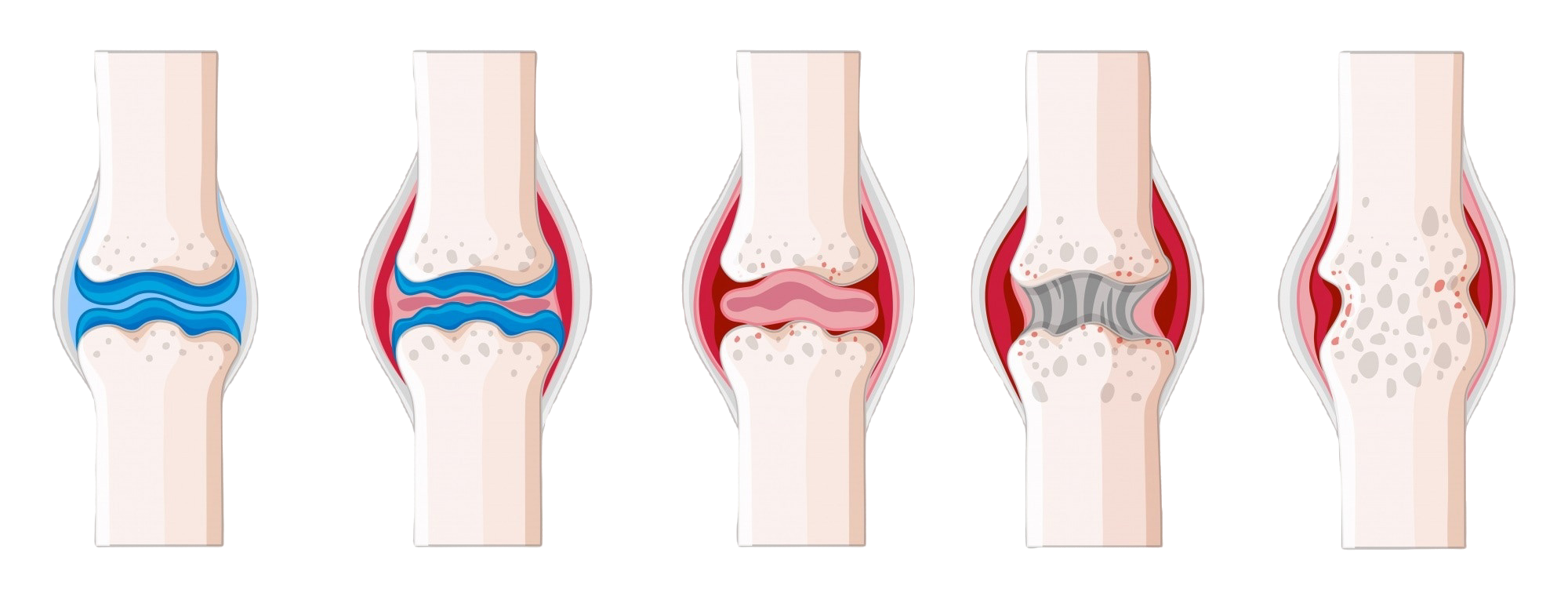 Benign Bone Tumor Removal Treatment In India