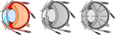 Development of Glaucoma