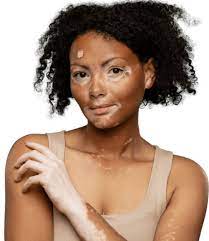 Understanding Vitiligo Treatment for Skin Restoration